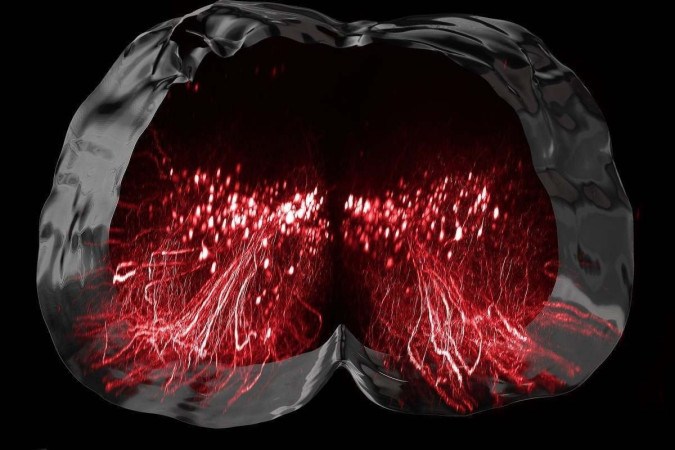 9 pessoas com paralisia voltam a andar após estimulação elétrica em neurônios